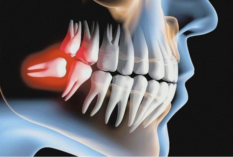 20’lik Diş Tedavisi