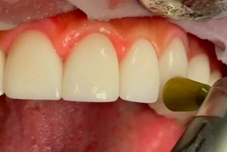 Bonding Uygulamaları