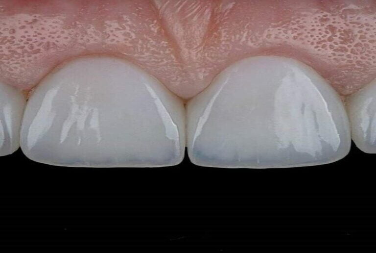 Dis-Eti-Estetigi-Pembe-Estetik