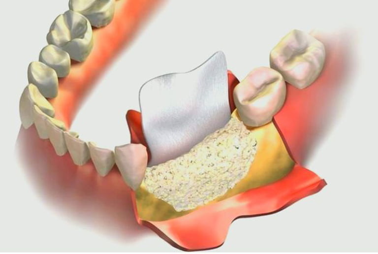 Kemik Grefti Uygulamaları