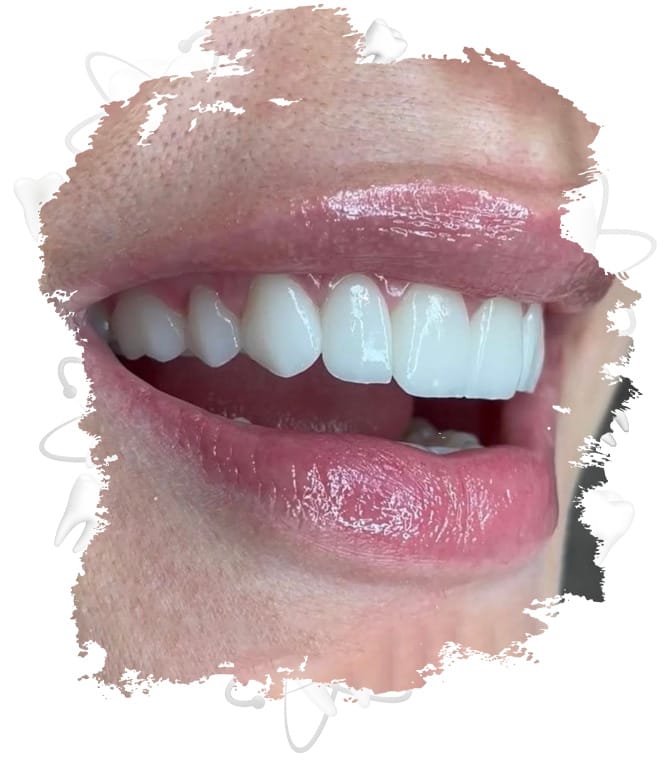 gülüş tasarımı fiyatları 2024