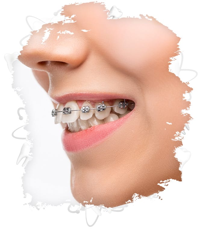 orthodontic treatment